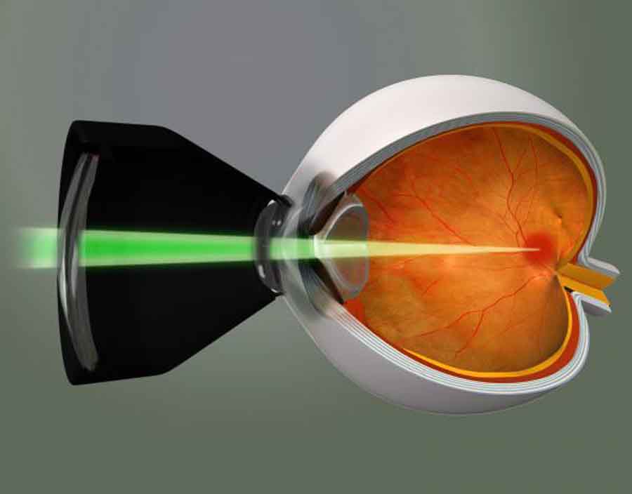 Прижигание сетчатки. Транспупиллярная лазеркоагуляция. Лазерная коагуляция сетчатки глаза. Офтальма лазерная коагуляция. Транспупиллярная лазеркоагуляция сетчатки.